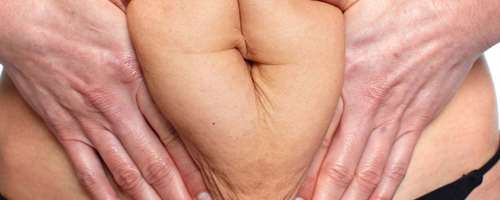 Mislukte liposuctie buik: Herstel en verbetering bij Clinique Dr. Don