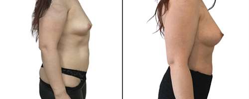 Is een borstvergroting van kleine strakke borsten met lipofilling mogelijk?